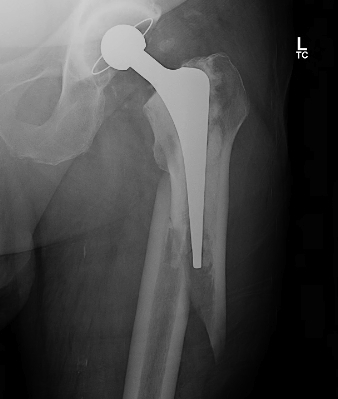 THR Periprosthetic Fracture